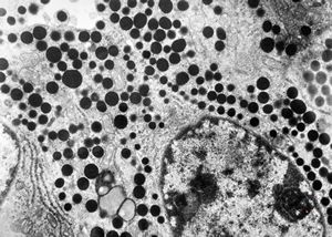 F, 41y. | acromegaly - acidophilic pituitary adenoma (STH)